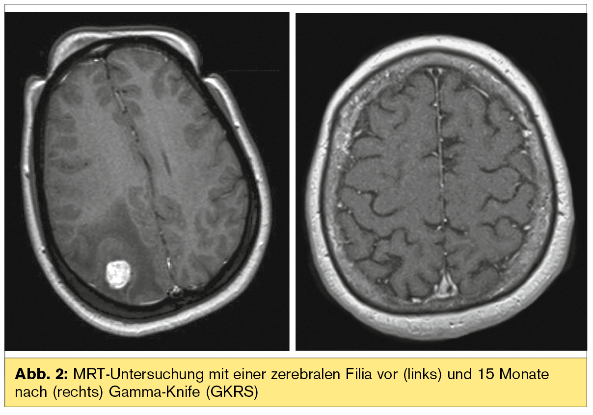 Multiple Sklerose Mrt Mrt Hws Weiße Flecken Multiple Sklerose Die diagnose von multipler